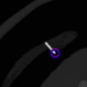 Needle Tip Tracking During CT-guided Interventions using Fuzzy Segmentation