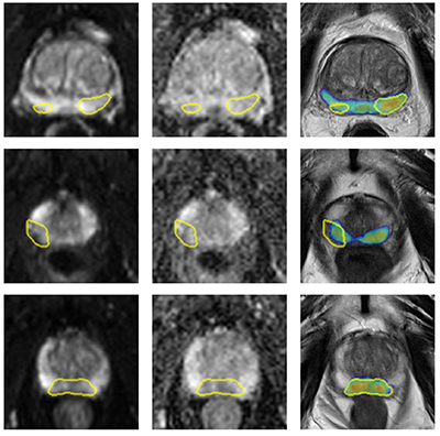 Automatic detection of prostate cancer grades and chronic prostatitis in biparametric MRI