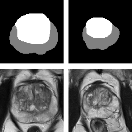 Augmenting Prostate MRI Dataset with Synthetic Volumetric Images from Zone-Conditioned Diffusion Generative Model