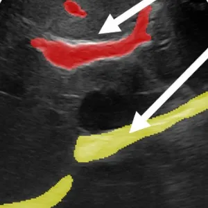 Fast Registration for Liver Motion Compensation in Ultrasound-Guided Navigation