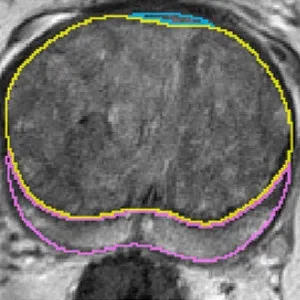 Towards Patient-Individual PI-Rads v2 Sector Map: Cnn for Automatic Segmentation of Prostatic Zones From T2-Weighted MRI