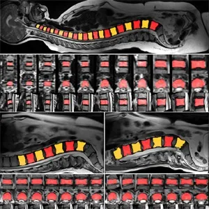 Combining convolutional neural networks and star convex cuts for fast whole spine vertebra segmentation in MRI