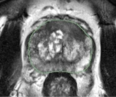 Anisotropic 3D Multi-Stream CNN for Accurate Prostate Segmentation from Multi-Planar MRI