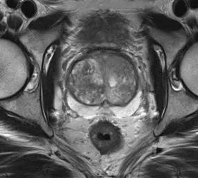 High Resolution Prostate Segmentations for the ProstateX-Challenge